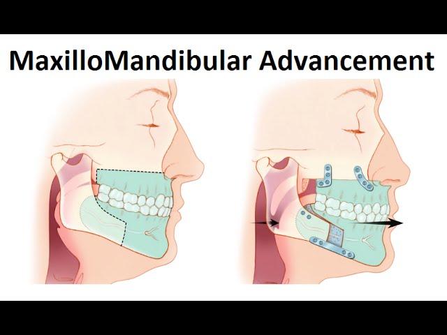 Surgical Treatment of Retruded Jaws (MaxilloMandibular Advancement Surgery) by Dr Mike Mew