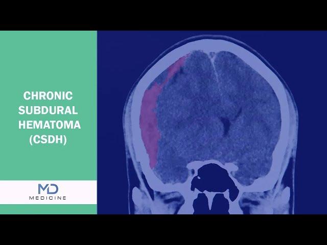 What is Chronic Subdural Hematoma (CSDH)? -  @mdmedicine-tv