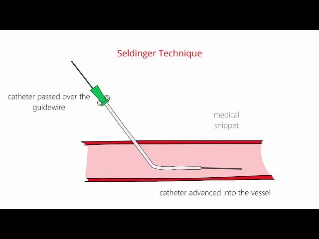 Seldinger Technique & Modified Seldinger Technique