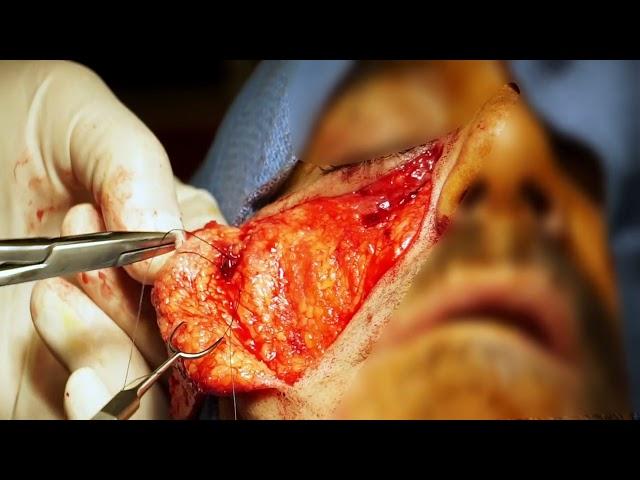 Blurred Facial Ulcer Repair March 2023