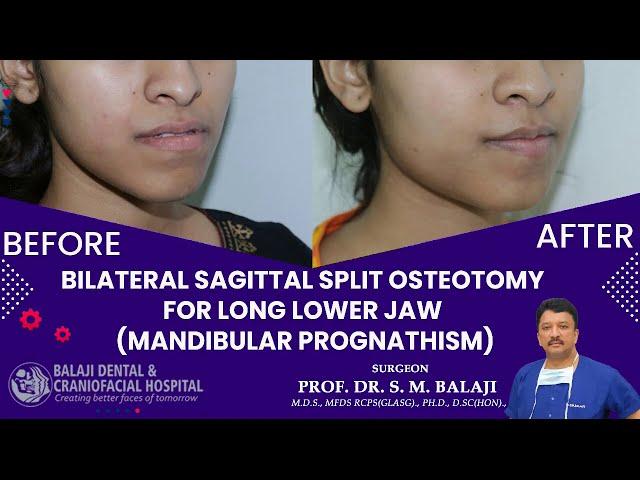 Bilateral Sagittal Split Osteotomy for Long Lower Jaw Mandibular Prognathism