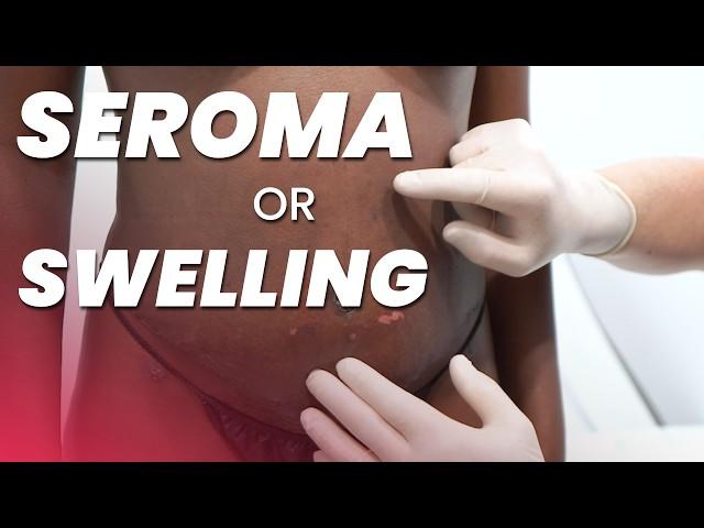 How to Handle Post-Op Swelling & Seroma Complications