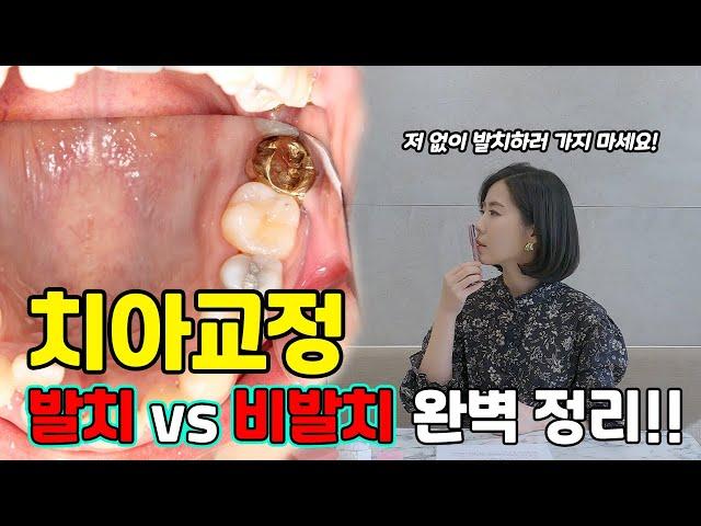 저 없이 발치하러 가지 마세요! 치아교정 발치 vs 비발치 완벽 정리!!