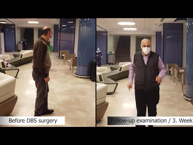 Change of Parkinson Patient Osman ÖCALIR with DBS Treatment | Doç. Dr. Ali ZIRH