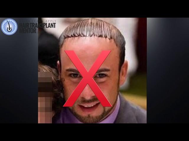 How To Take Hair Transplant Consultation Photos - by Joe Tillman