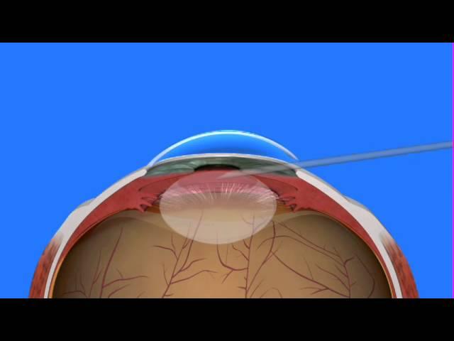 Cataract Surgery