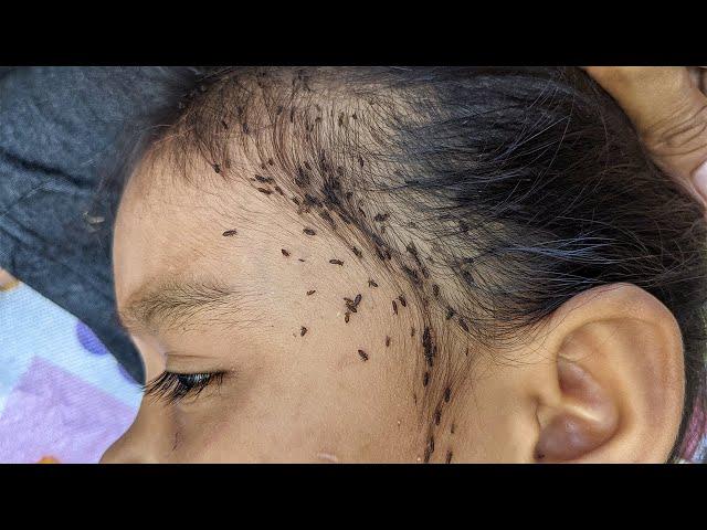 How to get rid all of head lice - Remove thousand lice from hair