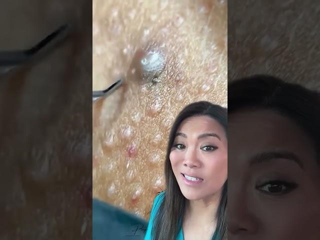 We call this a “collision pop”  An ingrown hair next to a comedone 