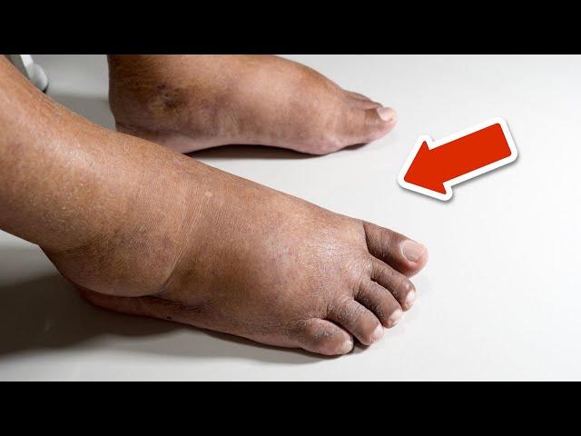 The BEST vitamin to remove swelling in the feet and legs