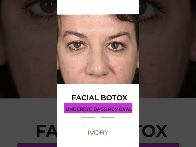 Magical under eyes filler and Botox with Dr. ORO