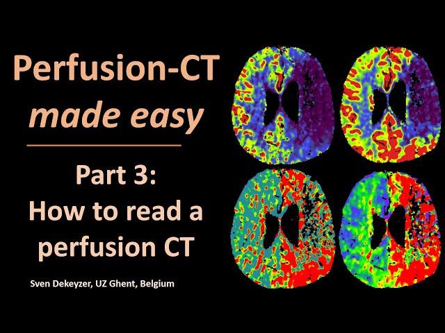 Perfusion CT made easy - part 3  - How to read perfusion CT?