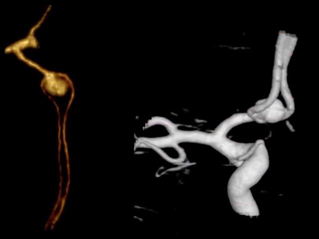 Previously Ruptured Coiled AcomA Aneurysm;  Now Recurrence!