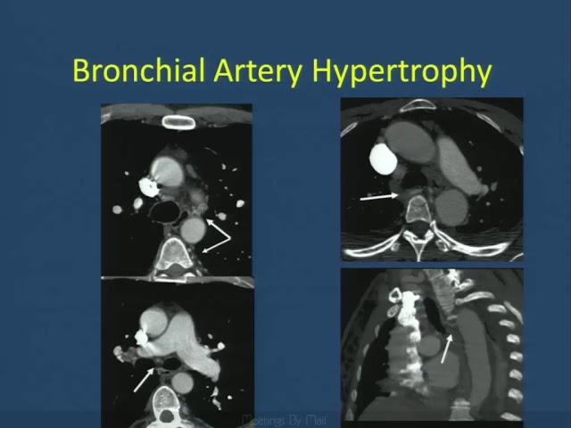 Imaging of Pulmonary Hypertension-- Philip Costello, MD (SCBT-MR/SABI 37th Annual Course)