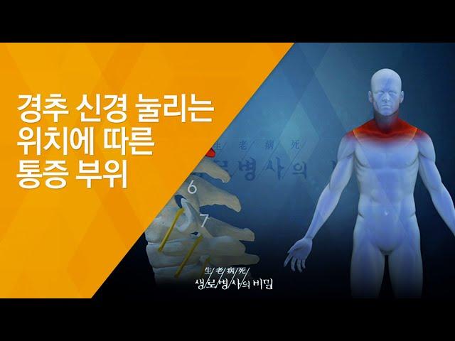 경추 신경 눌리는 위치에 따른 통증 부위 - (20140917_517회 방송)_우리 몸이 흔들린다 목 질환의 경고!