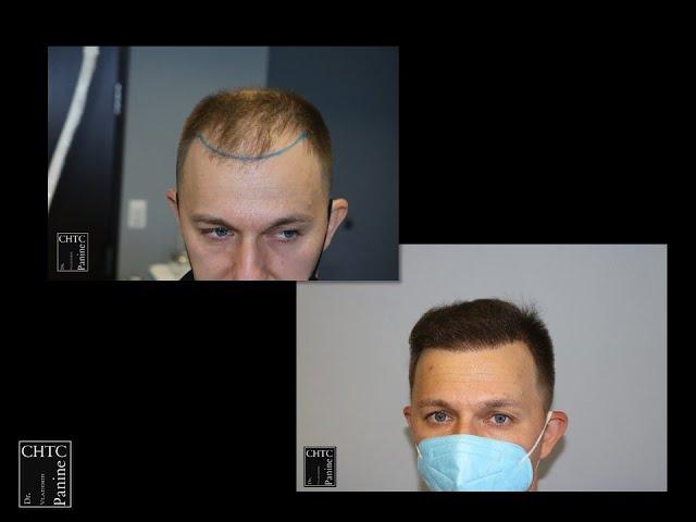 Before and After Photos of FUE Hair Transplant with 2,550 Grafts  at Chicago Hair Transplant Clinic