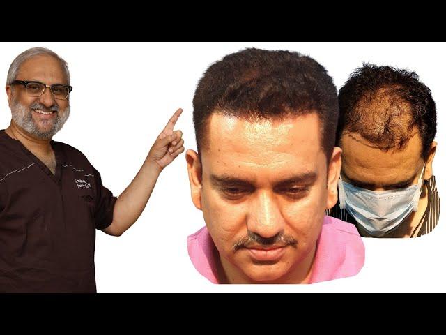 Comprehensive Tips for a Hair Transplant in India for Best Hair Transplant Result