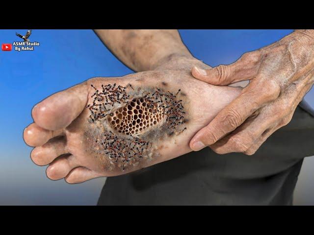 ASMR Treatment Animation Remove Maggots Infection | ASMR Foot Treatment | ASMR 2d Animation Cleaning