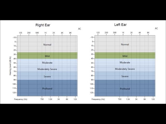 The Hearing Center at Jacksonville Hearing & Balance Institute - How To Read An Audiogram