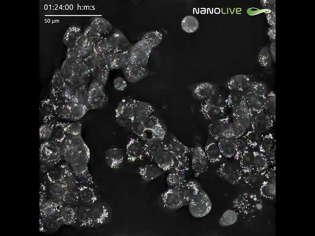 Accumulation of lipid droplets (LDs) in human pancreas adenocarcinoma cells