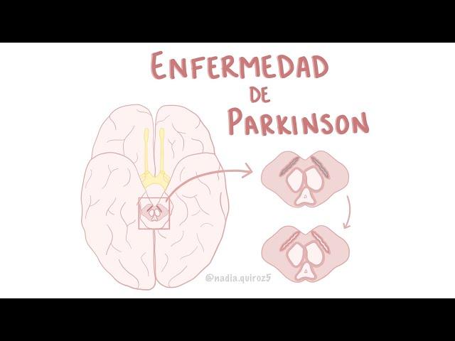 Enfermedad de Parkinson