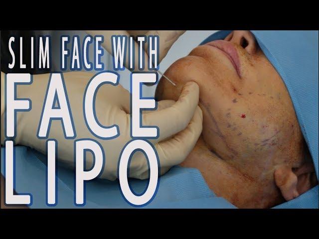 Get Rid of Extra Fat on your Face with Microliposuction