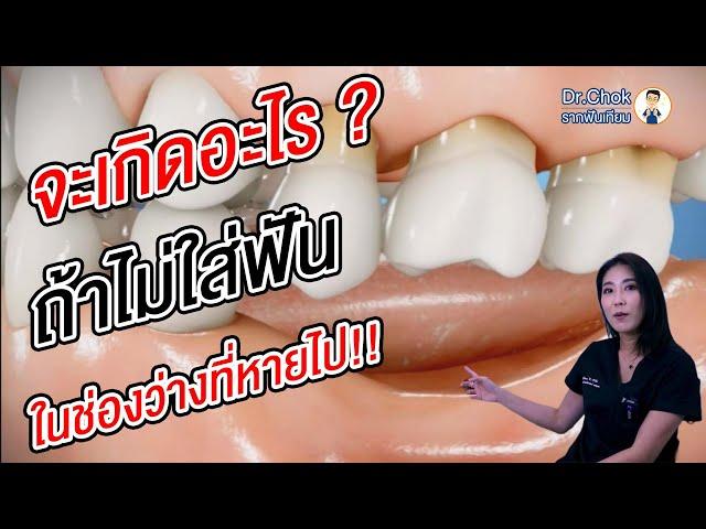 ถอนฟันไปแล้ว ไม่ใส่ฟันปลอม จะเกิดอะไรขึ้น ? | คลายปัญหาฟันกับทีมหมอโชค