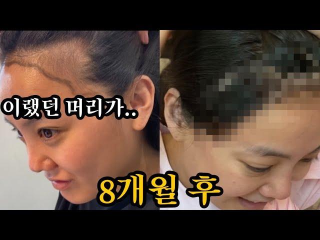 모발이식 8개월 후...충격적인 고은아의 현 상태..