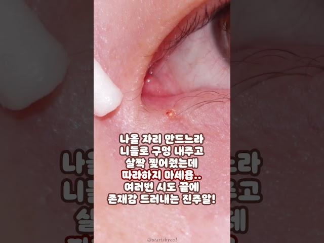 절대 따라하지 마세요.. 구경만 하세요.. #비립종