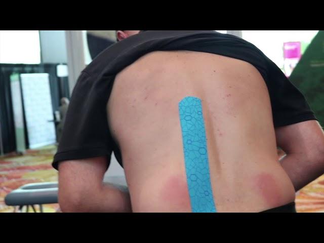 Evaluation and Taping of Lumbar Myofascial Pain and Dysfunction