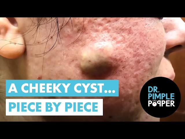 A Cheeky Cyst... Piece by Piece