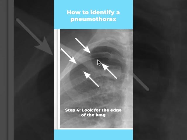 How to identify a pneumothorax (in 5 easy steps) #shorts