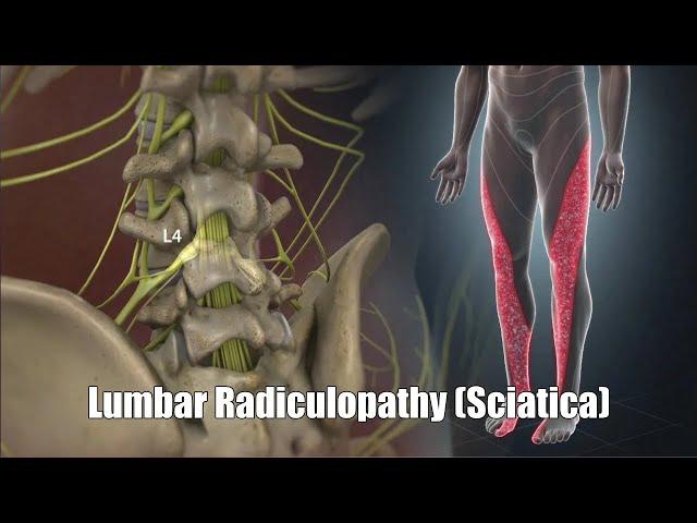 Lumbar Radiculopathy (Sciatica)