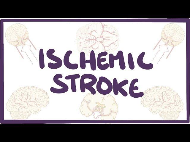 Ischemic Stroke - causes, symptoms, diagnosis, treatment, pathology