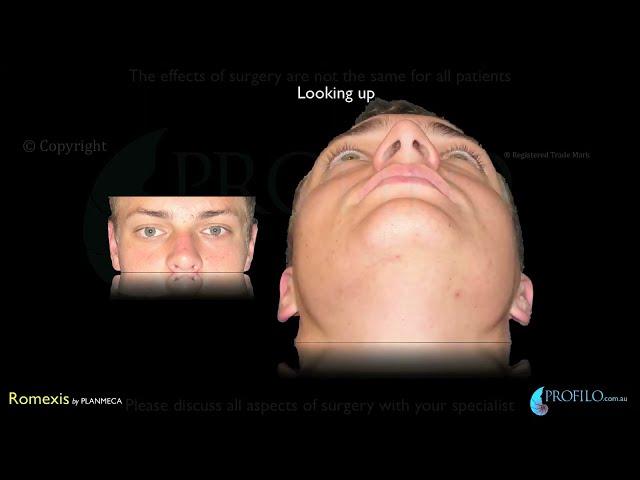 Orthognathic Jaw surgery & oral and maxillofacial surgery using CT 3D imaging