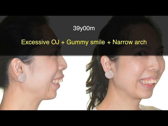 Excessive Overjet and Gummy Smile Treated with Clear Aligners｜【Chris Chang Ortho】CC671