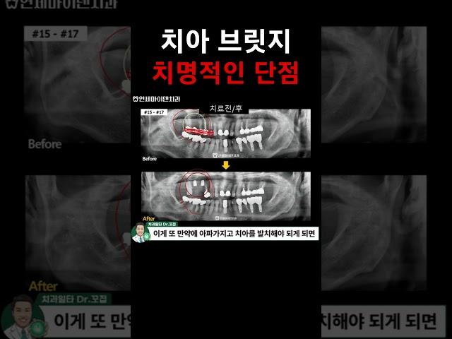 치아 브릿지 단점, 오래된 브릿지 교체가 필요하다면?