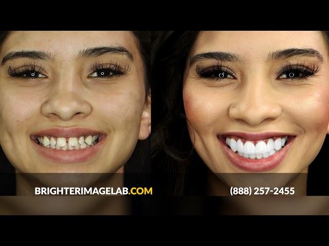 Affordable Smile Makeover w/No Dentist ! New Online Dental Veneers by Brighter Image Lab