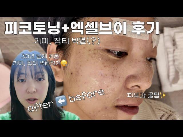 난생 처음 기미잡티 제거하러 피부과 피코토닝+엑셀V 비타민관리까지 내돈내산 후기