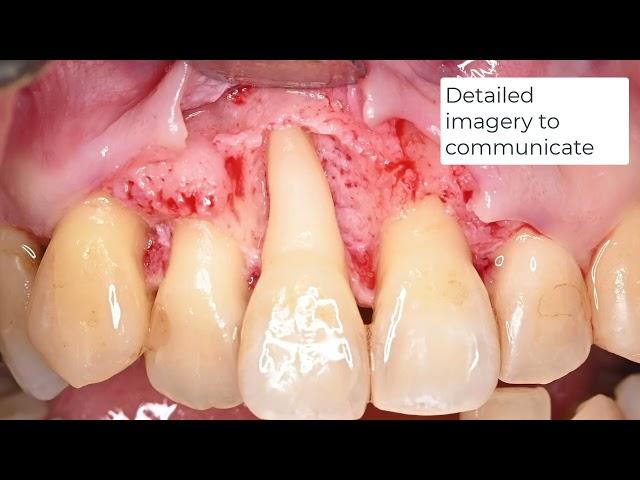 HAp/Col Treatment and the Mielscope Dental Microscope
