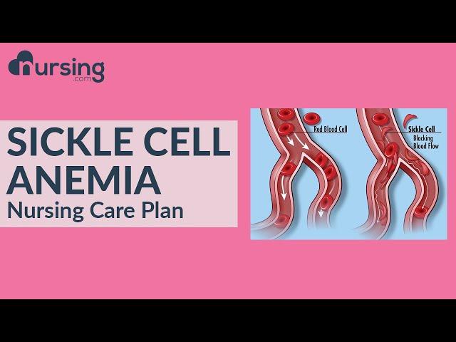 Complete Care Plan for Sickle Cell Anemia (Nursing Care Plan Tutorial)