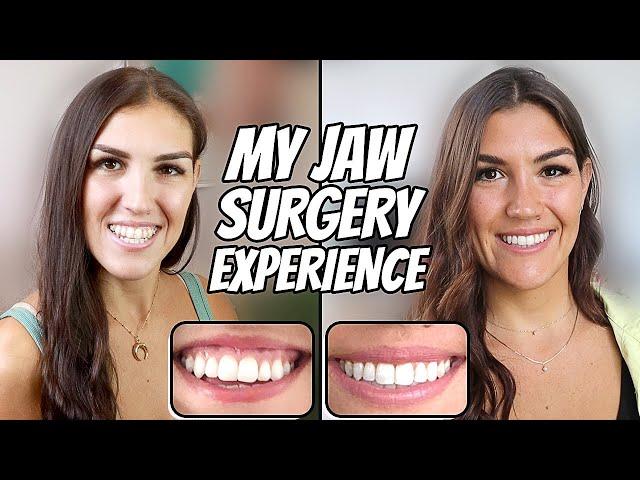 My Double Jaw Surgery Experience 2022 (Before and After 5 Months Post Op)