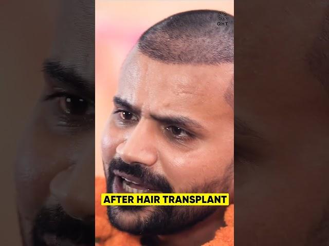 Youtuber Topa Bhai ( Nadeem Bunny ) Hair Transplant Progress #shorts#hairtransplant