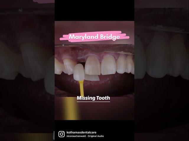 Missing Front Tooth Replaced With Maryland Bridge- by Dr.Praneeth