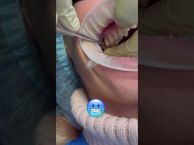 #удалениезуба #стоматология #клиникамосква #имплантация #имплантация #tooth