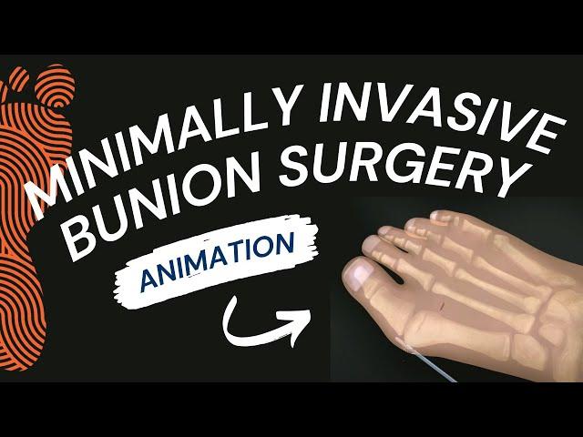 Minimally Invasive Bunion Surgery: A Short Animation