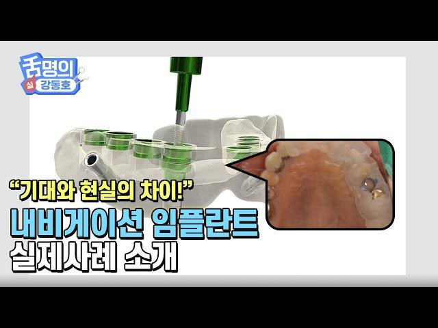 임플란트 수술방법 내비게이션 하면 무조건 좋을까? 기대와 현실의 차이!