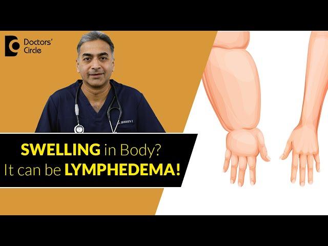 Swollen Limbs Treatment | Lymphedema Causes & Treatment   - Dr. Srikanth V| Doctors' Circle