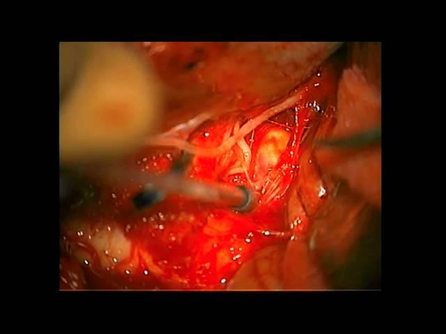 Microsurgical clip reconstruction techniques for aneurysms with significant calcified neck