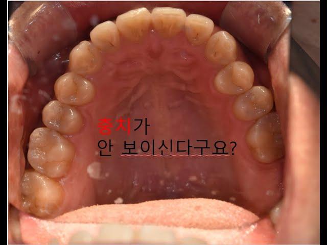 [부산치과추천] 인레이가 깨질 때의 원인과 해결방법(광안리 뉴욕치과 4-6-1)