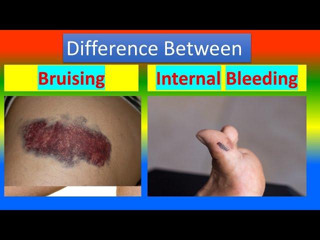 Difference between Bruising  and Internal Bleeding